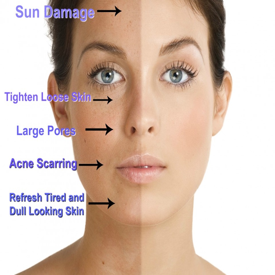 Chemical Peels: The Correct Approach to Anti-Aging and Skin Rejuvenation